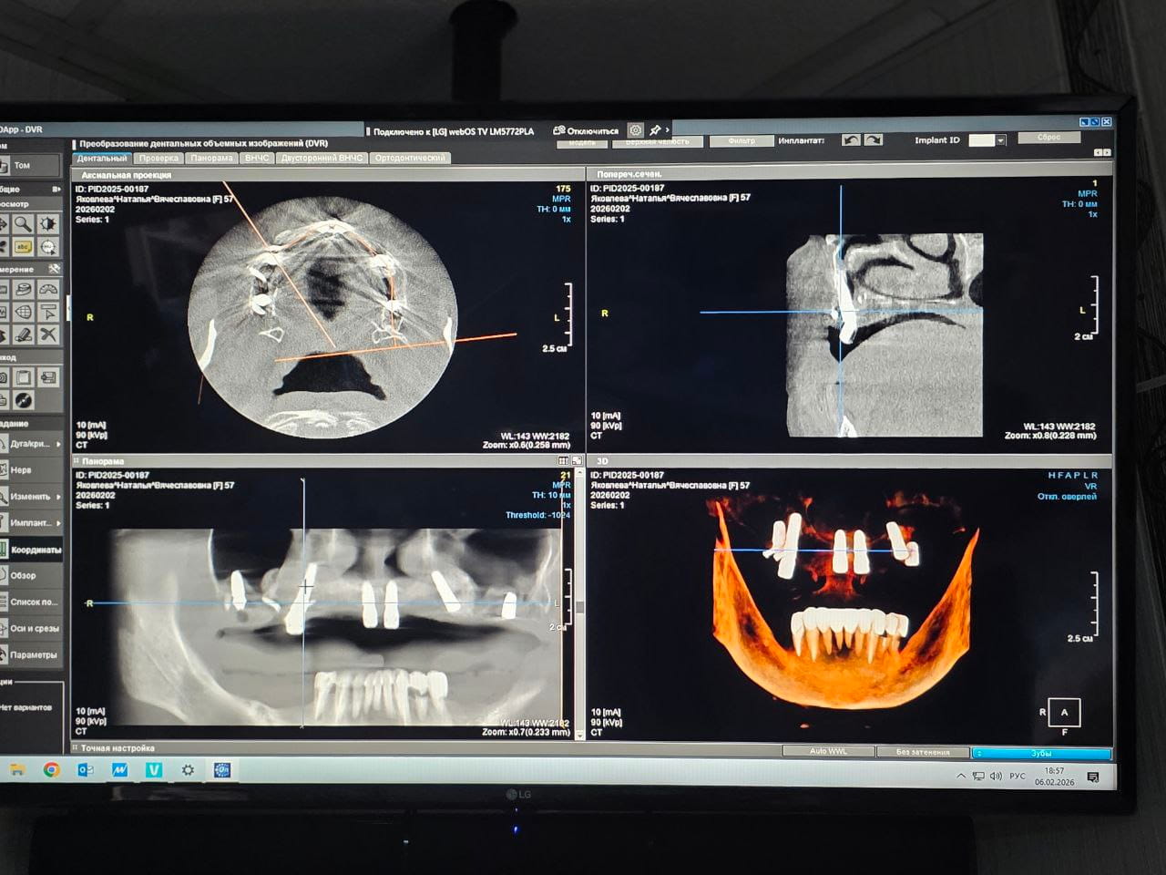 Компьютерная томография